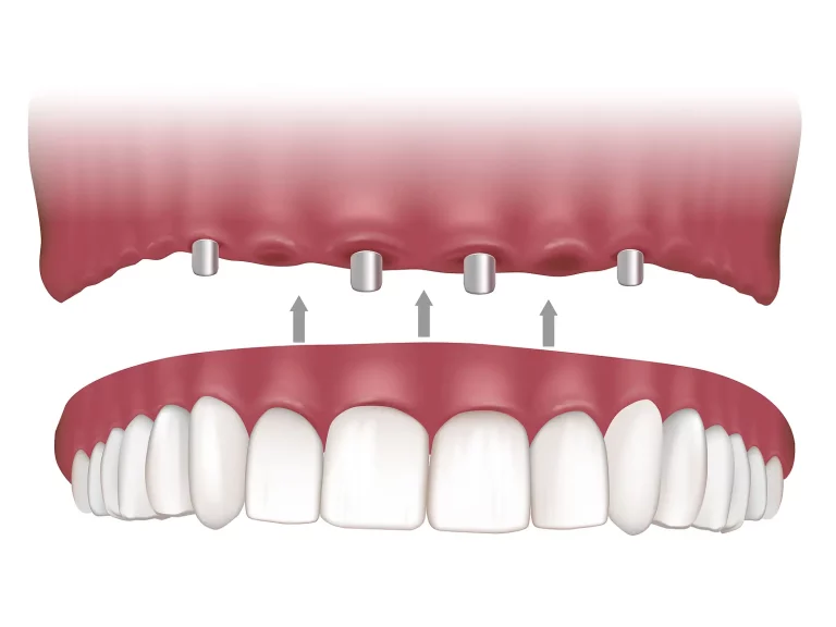 Patient consultation for All-on-4 at A Dental Center North Hollywood