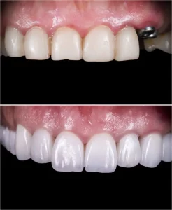 Dental Implants in North Hollywood, CA