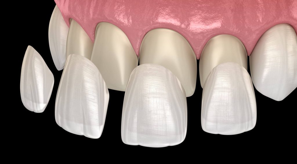 Porcelain Veneers Los Angeles