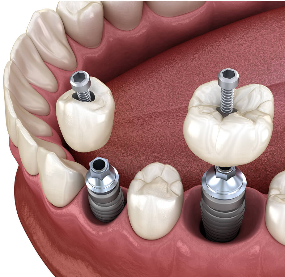 Same day dental implants