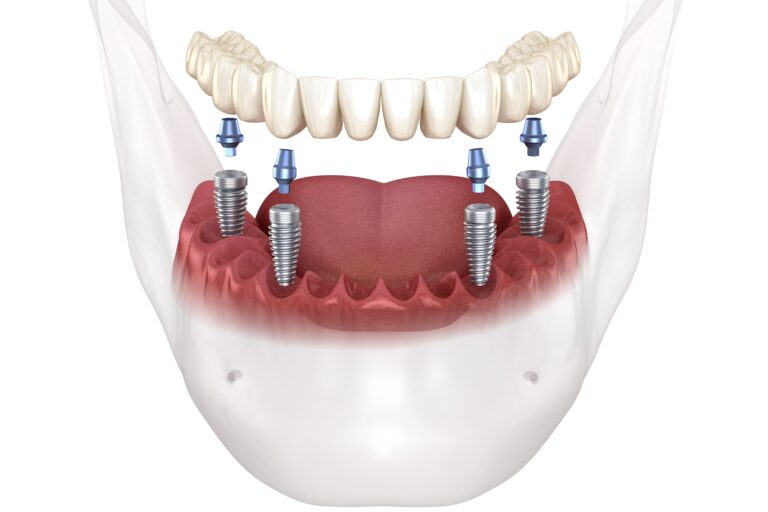 Diagram showing four implant placement positions for All-on-4 procedure