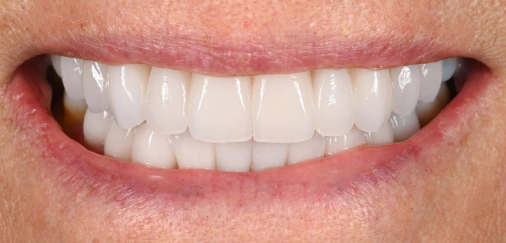 Pocelain Veneers