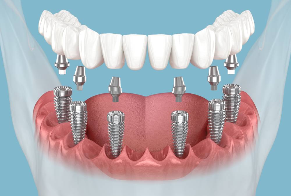 Dental Implants in North Hollywood