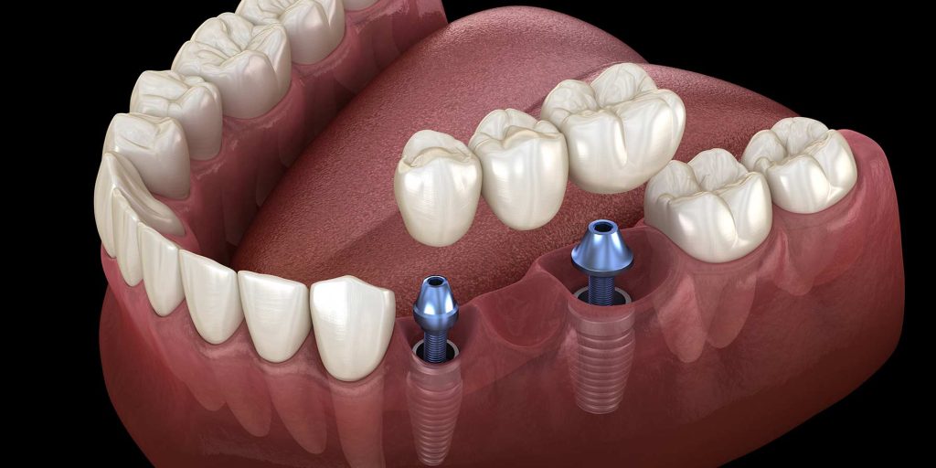 Dental Implants All-on-4 vs. Dentures How an implant-supported bridge works