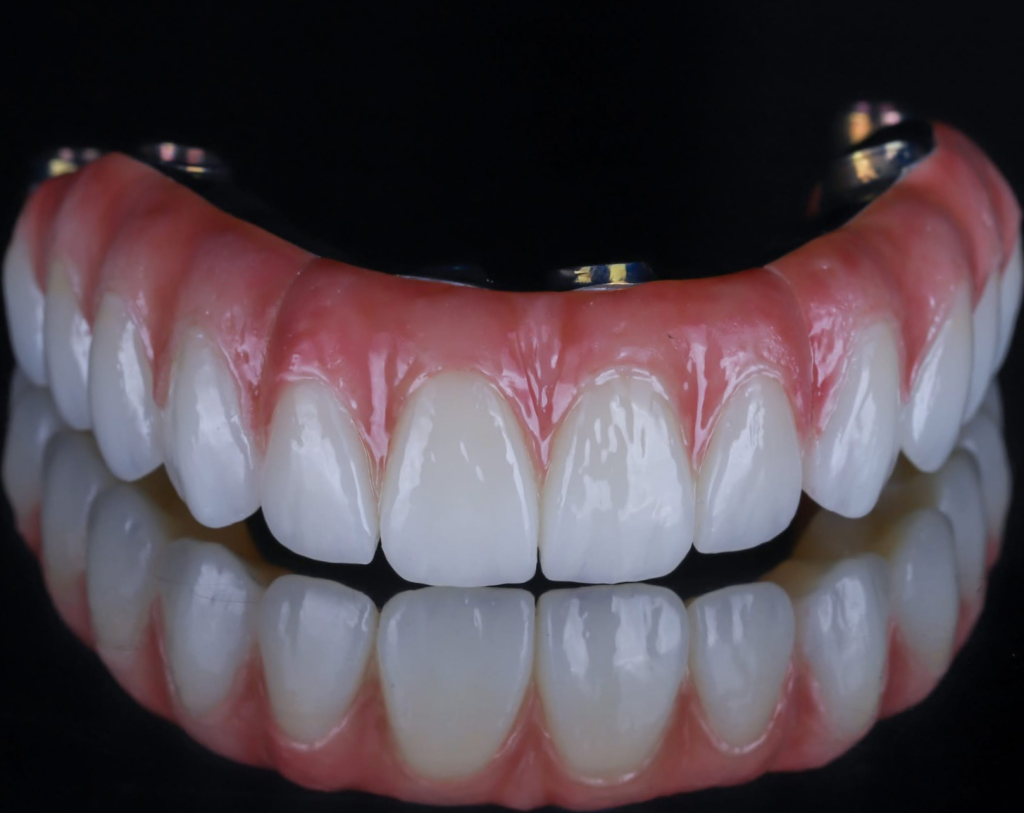 All-On-4 Restoration