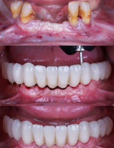 All-on-4 before and after smile transformation — A-Dental Center North Hollywood