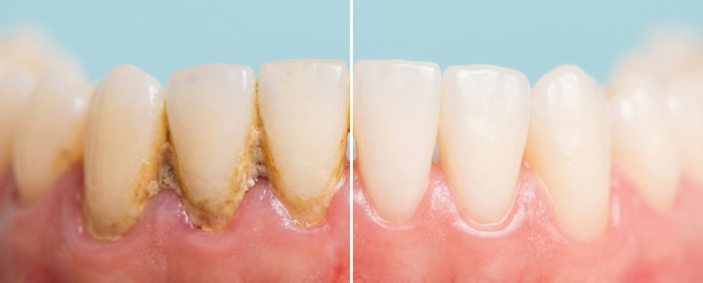 Deep cleaning dentist North Hollywood — scaling root planing gum disease A-Dental Center