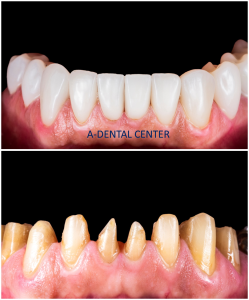 Dental crown fell off North Hollywood — what to do right now, A-Dental Center same day emergency