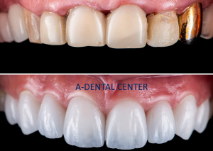Porcelain dental crown tooth restoration North Hollywood — A-Dental Center