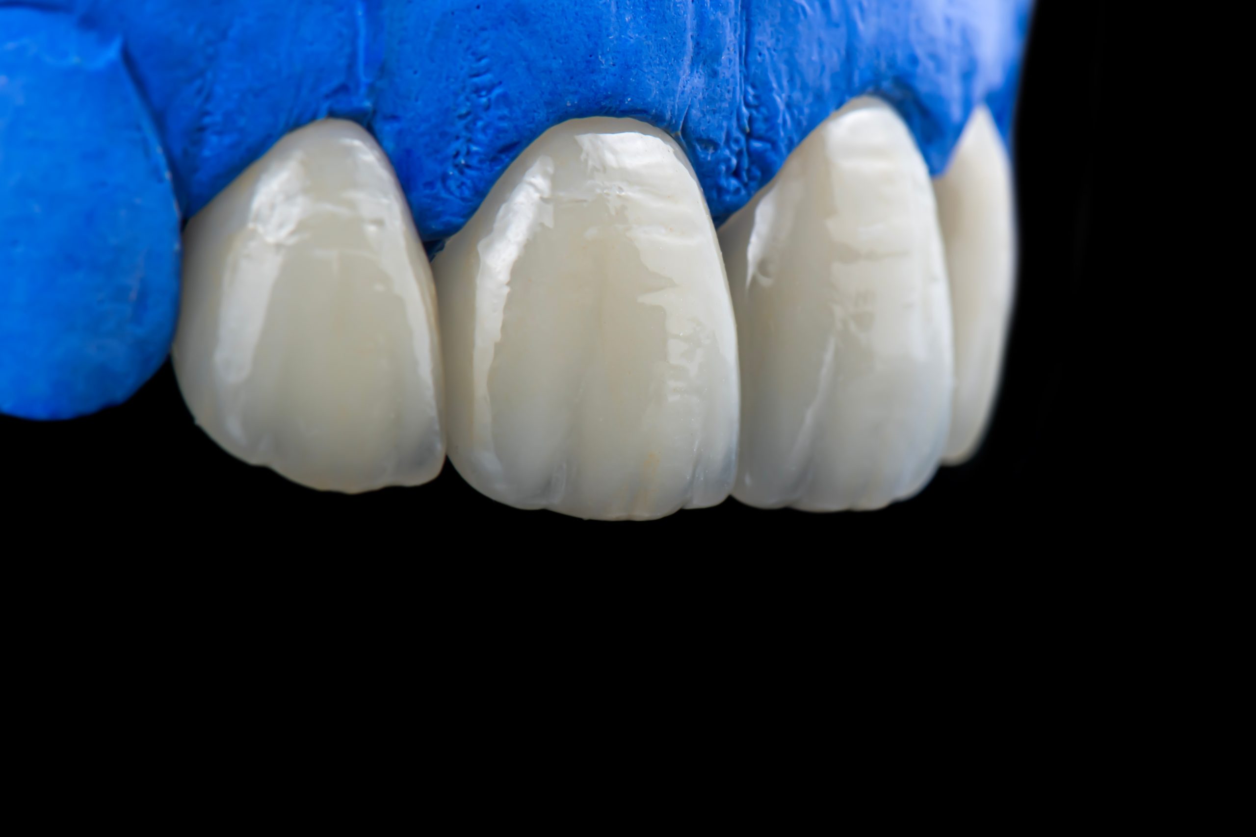 Dental crown North Hollywood — porcelain crown restoration process A-Dental Center