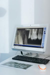 Digital X-rays dental checkup North Hollywood — low radiation diagnostic A-Dental Center