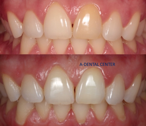 Does teeth whitening damage enamel North Hollywood — professional whitening A-Dental Center