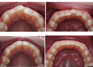 Invisalign clear aligner results straight teeth North Hollywood — A-Dental Center discreet