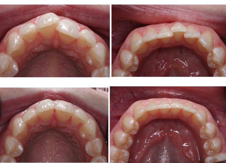 Invisalign before and after crowded teeth and crossbite — 14 month treatment by Dr. Elzayat, North Hollywood CA
