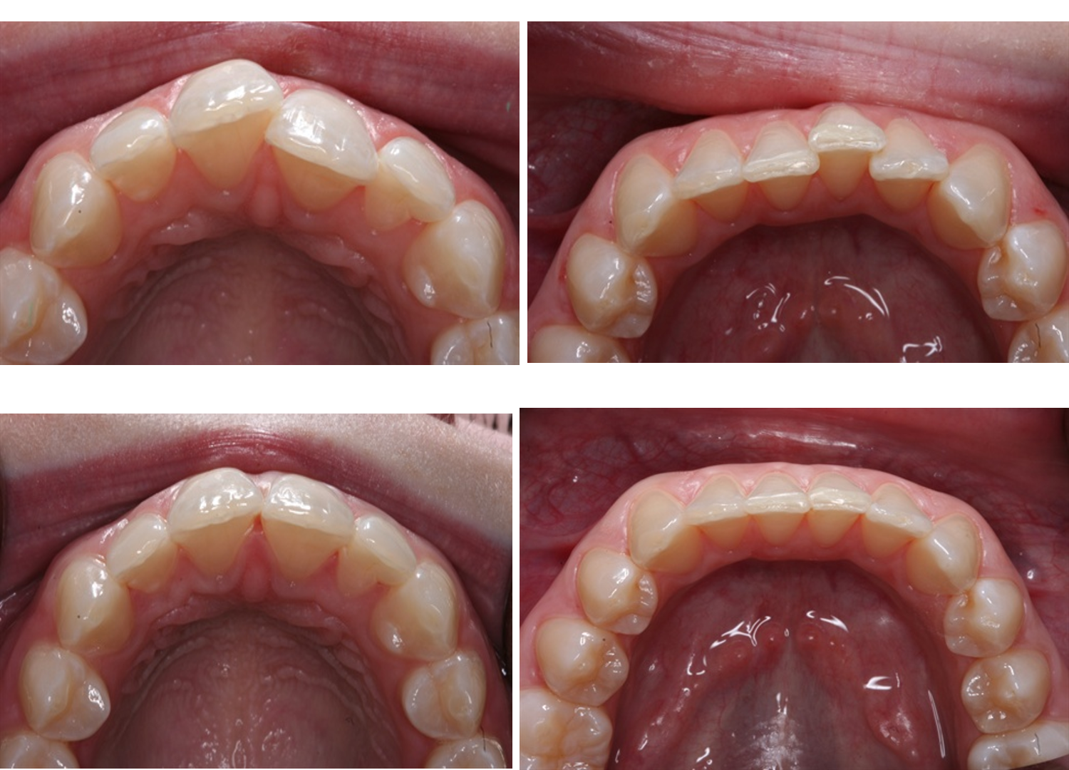 Invisalign before and after crowded teeth and crossbite — 14 month treatment by Dr. Elzayat, North Hollywood CA