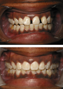 Invisalign before and after results North Hollywood — A-Dental Center straight teeth