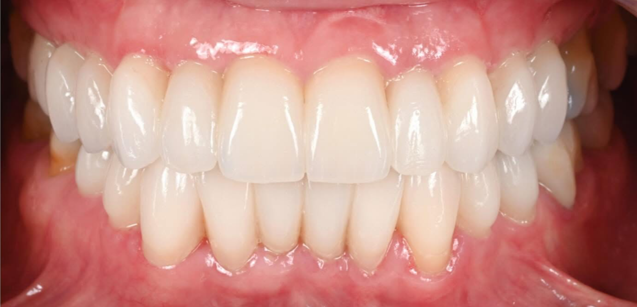 Are veneers permanent North Hollywood — porcelain veneers correcting crowding at A-Dental Center