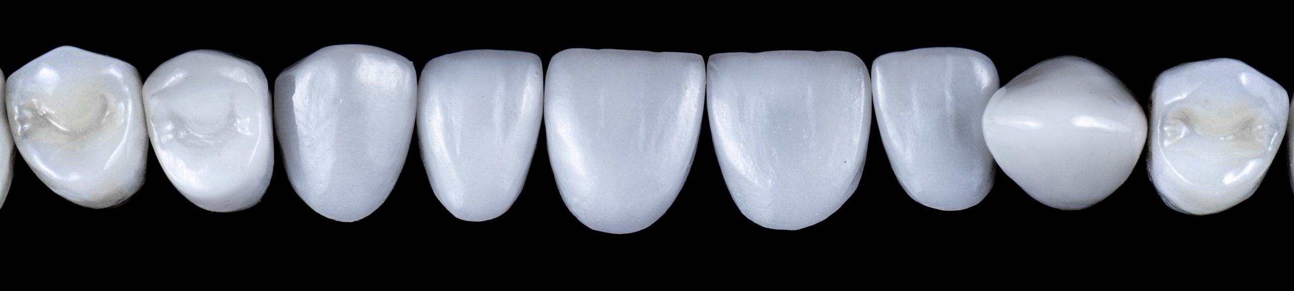 Porcelain veneers vs composite veneers North Hollywood — comparison A-Dental Center