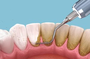 Scaling root planing deep cleaning procedure North Hollywood — A-Dental Center periodontist