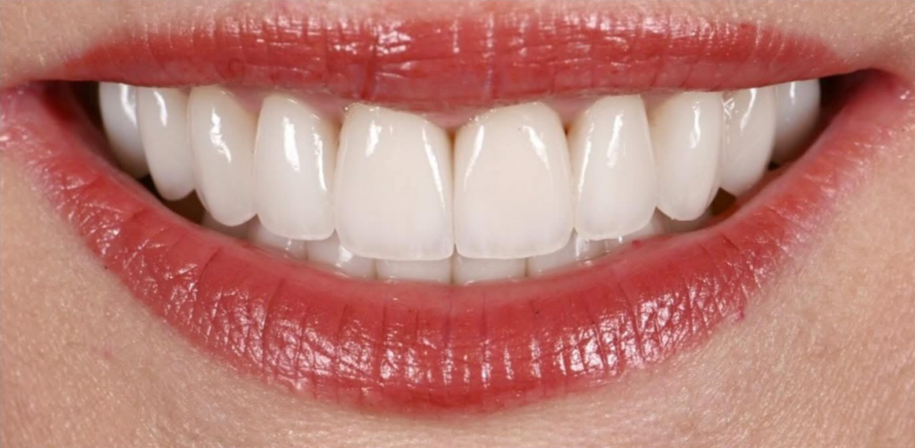 Veneers cost North Hollywood — porcelain veneer smile makeover A-Dental Center pricing
