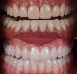 Veneers cost North Hollywood smile makeover before and after — A-Dental Center
