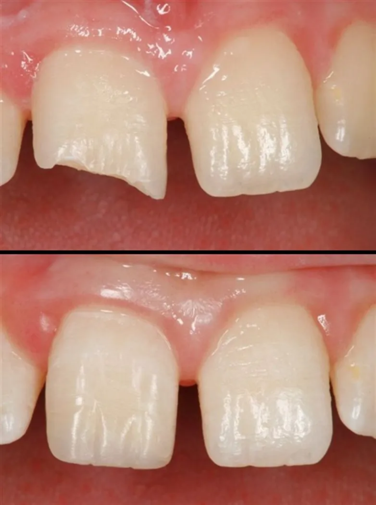 Composite bonding for chipped front tooth before and after — single visit repair by Dr. Elzayat, North Hollywood CA
