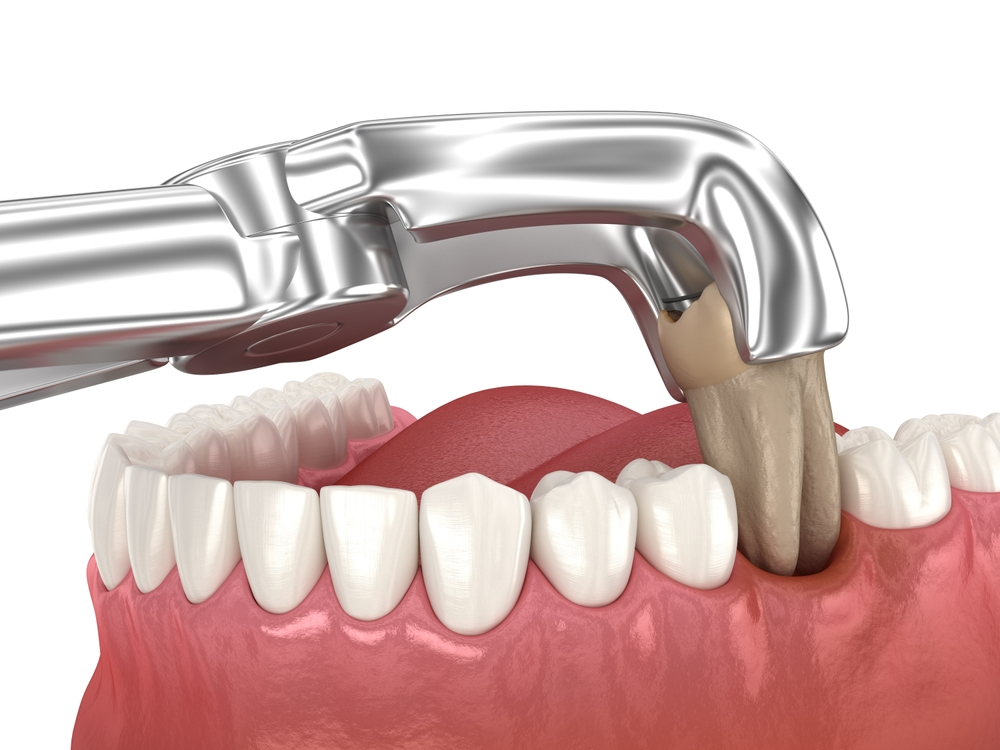 Tooth Extraction in North Hollywood post and core