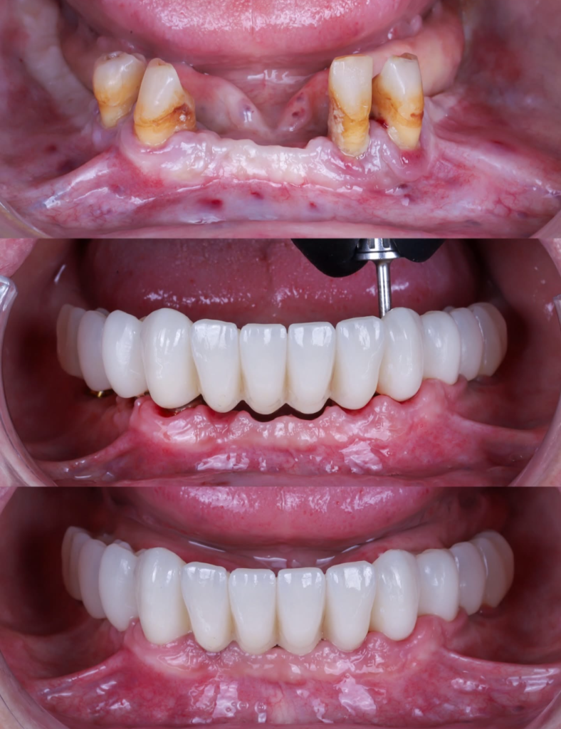 Fully edentulous mandibular arch · Same-day immediate load implant placement · Fixed hybrid denture delivered day of surgery