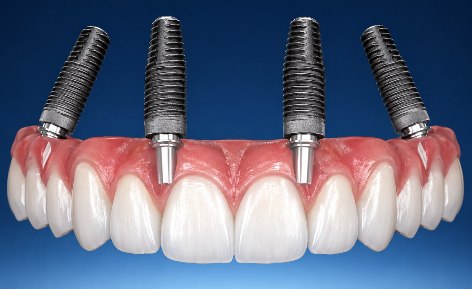 All-on-4 Dental Implants North Hollywood | Dr. Elzayat | From $16,000