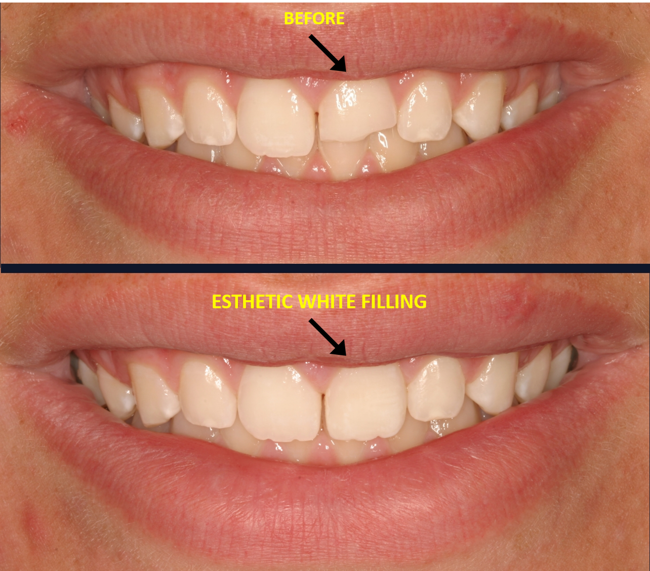 Composite Bonding North Hollywood, CA