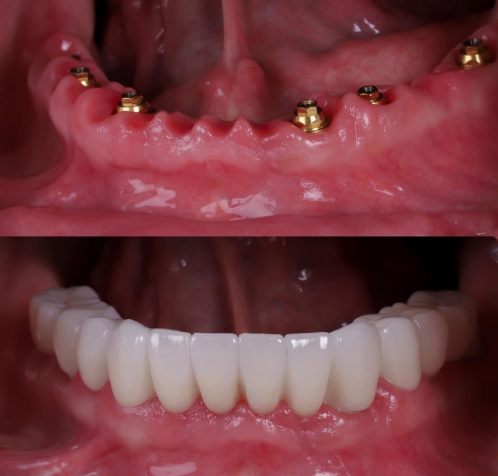 All-on-4 recovery — upper arch abutments with gold implant connectors day of surgery, final fixed arch restoration below, A-Dental Center North Hollywood CA