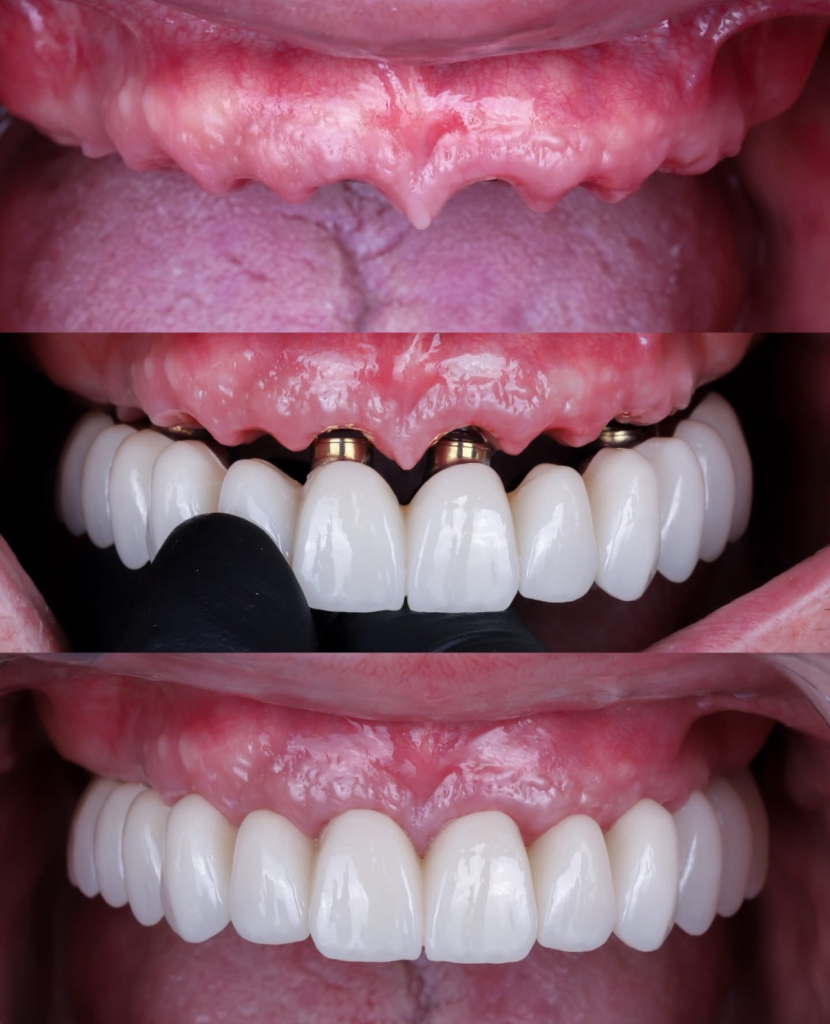 Atrophic maxilla — previously told "not a candidate" elsewhere · All-on-4 placed without bone grafting · Zirconia full arch final restoration. Total treatment time - 5 months.