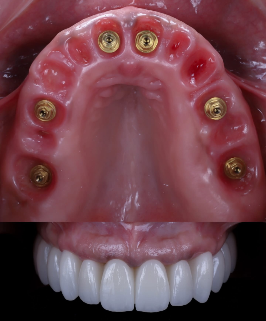 All-on-6 zirconia bridge before and after — upper arch abutments placed with gold implant connectors visible, final zirconia restoration below, A-Dental Center North Hollywood CA