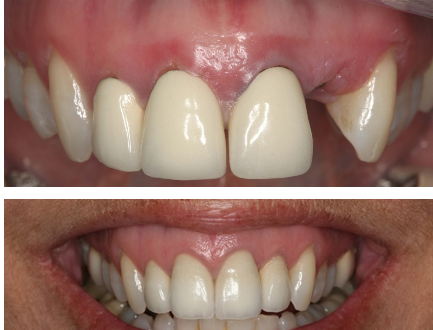Dental implant case result at A-Dental Center North Hollywood