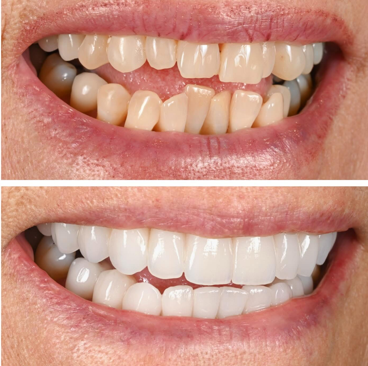 Upper porcelain veneers and Zoom whitening before and after - A-Dental Center