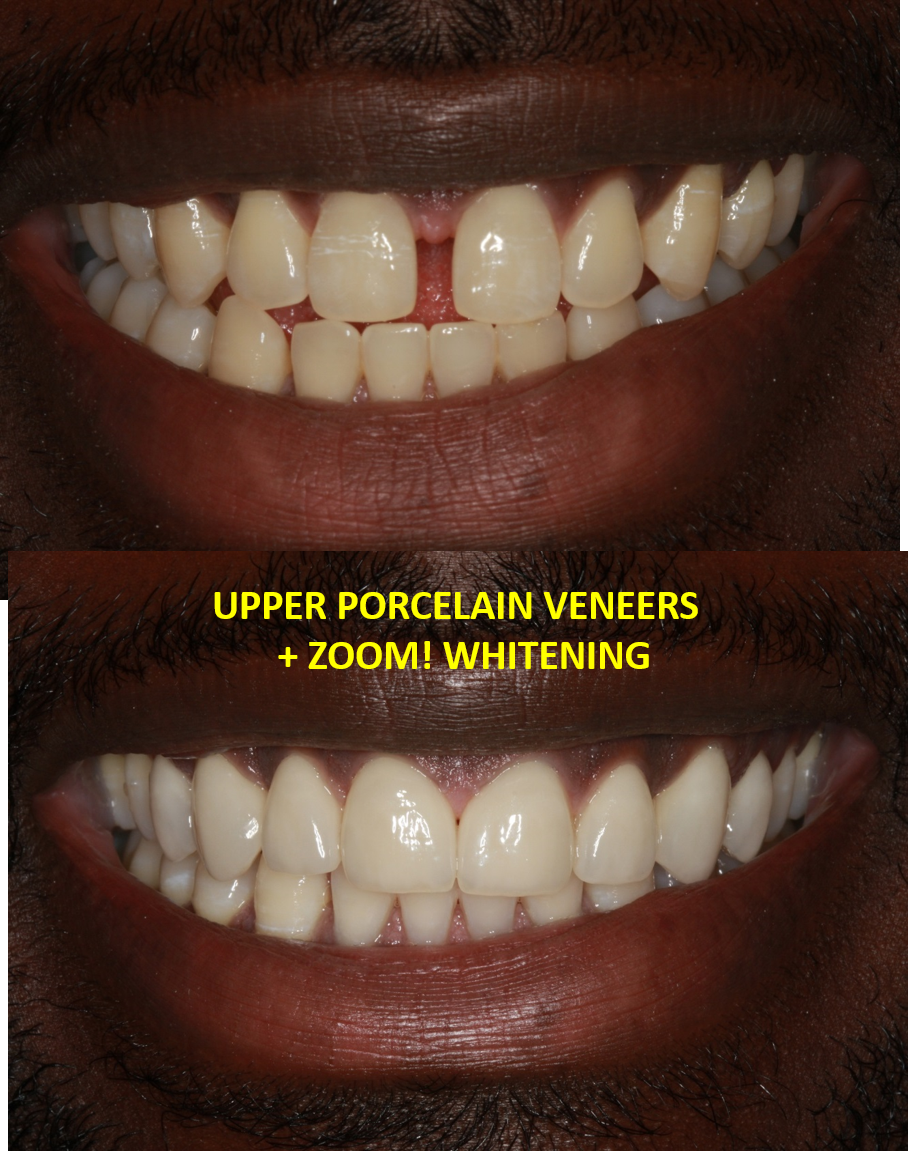 Porcelain veneers Los Angeles before and after - A-Dental Center North Hollywood