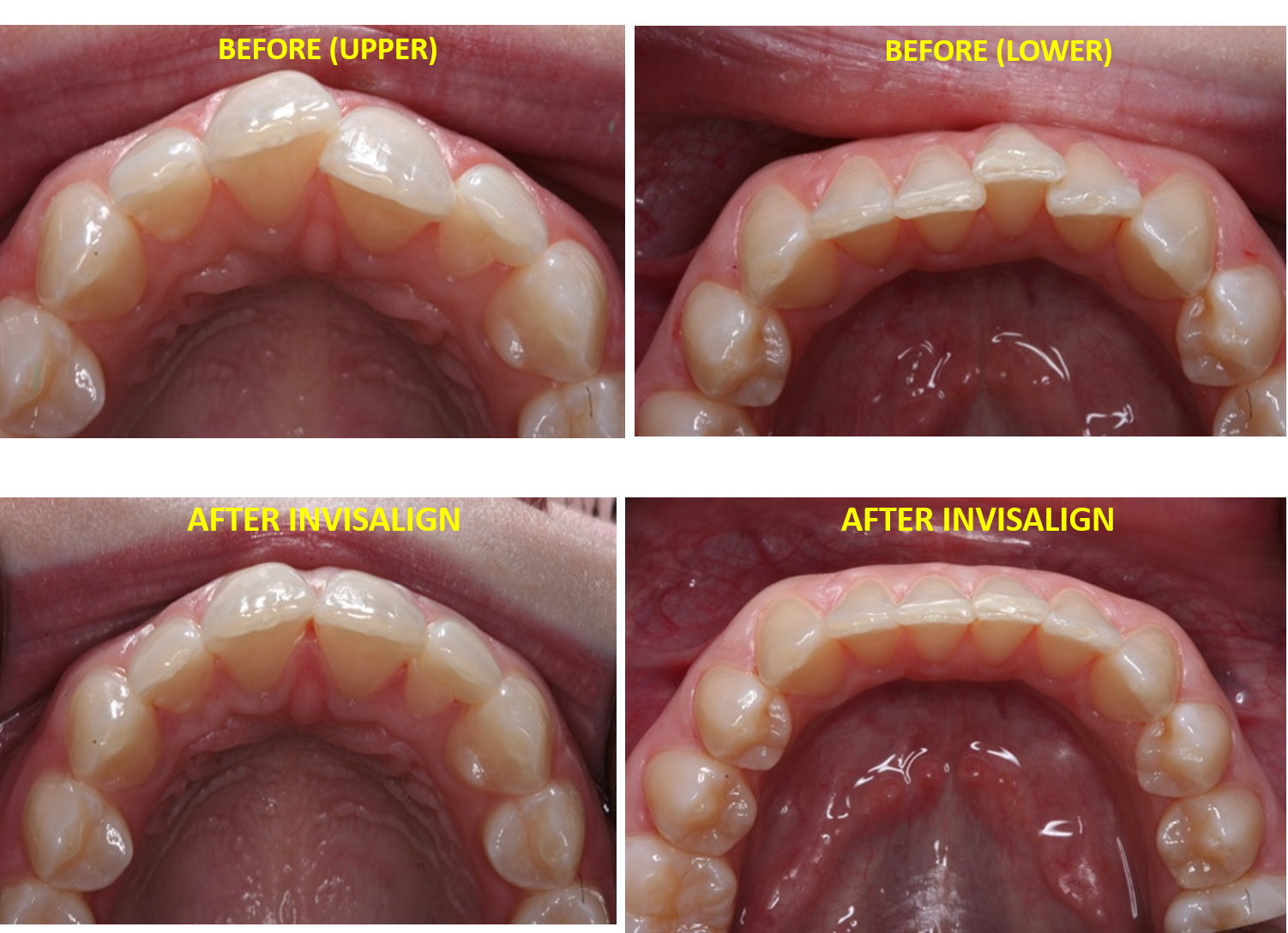 Invisalign teen before after gap teeth North Hollywood A-Dental Center