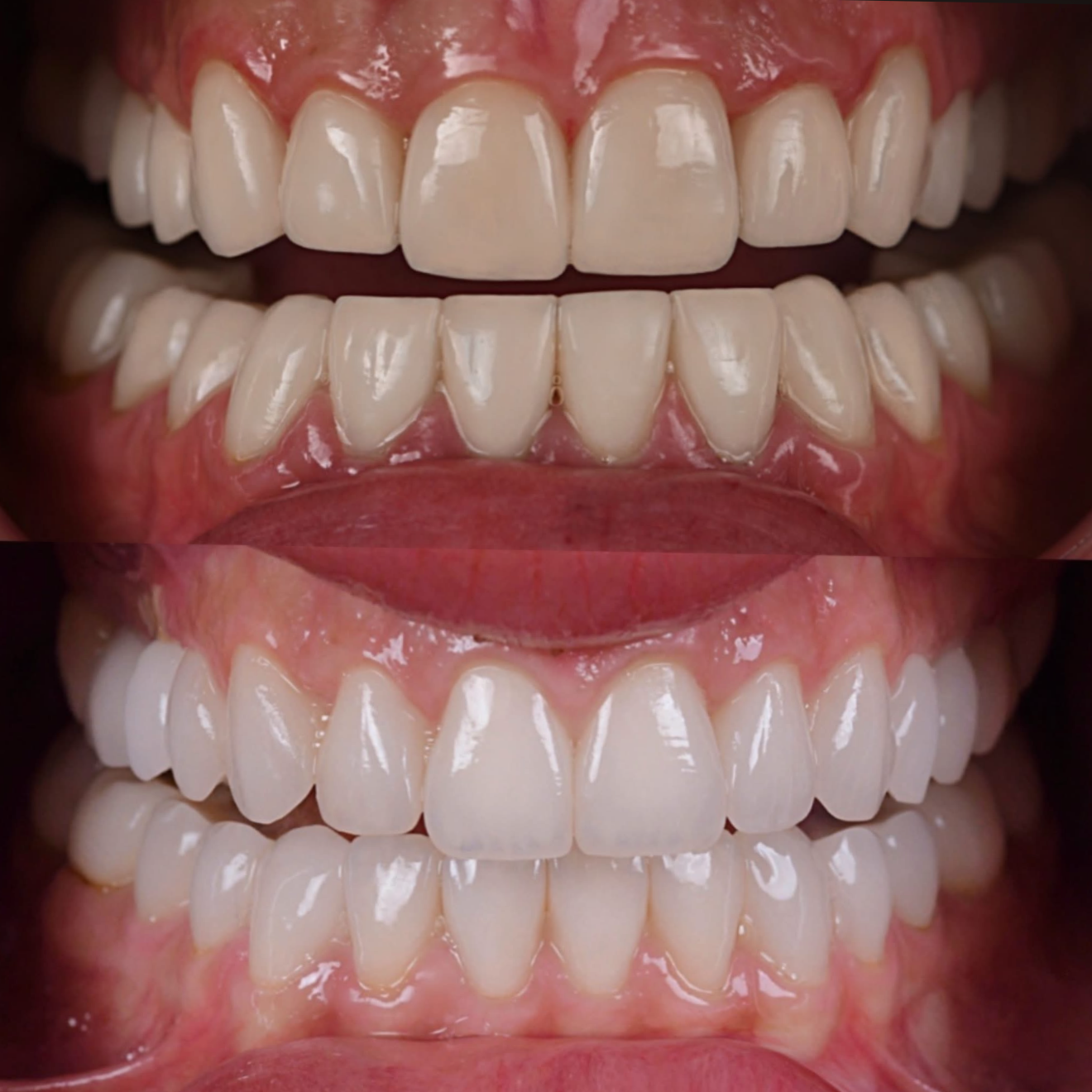 Porcelain veneers before and after North Hollywood patient - A-Dental Center