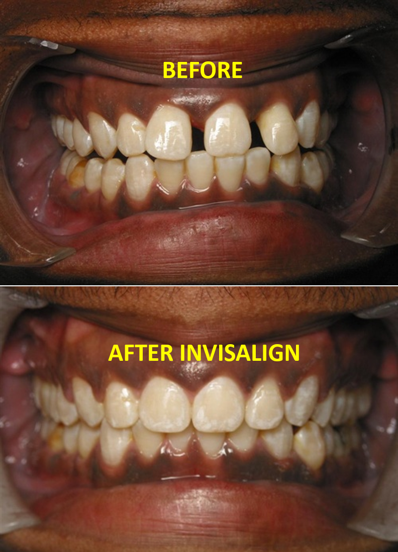 Invisalign teen before after crowding North Hollywood A-Dental Center