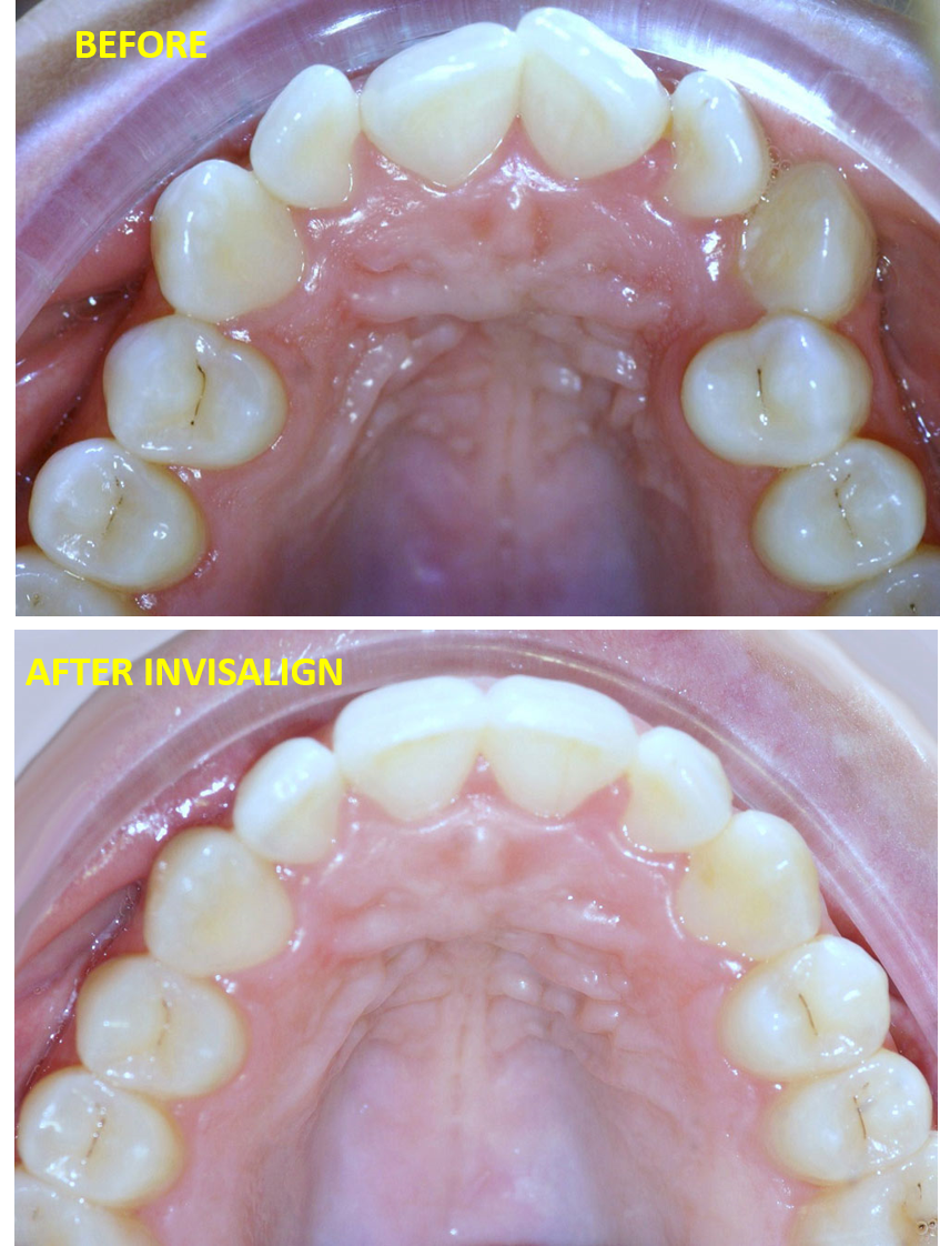 Invisalign teen before after overbite North Hollywood A-Dental Center