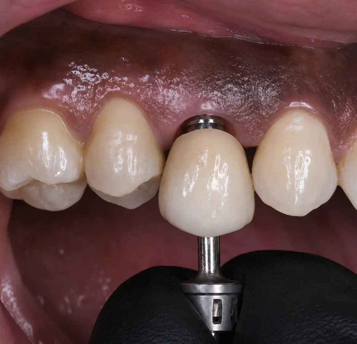 Upper lateral incisor dental implant with zirconia crown before and after