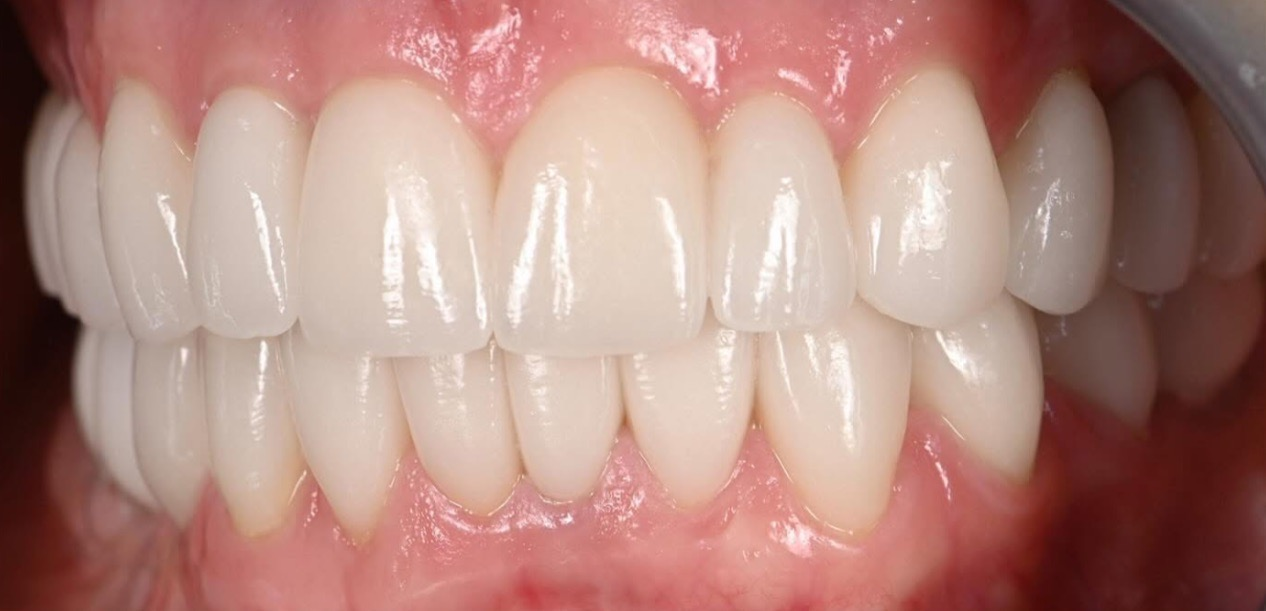 Smile Makeover Cost in North Hollywood