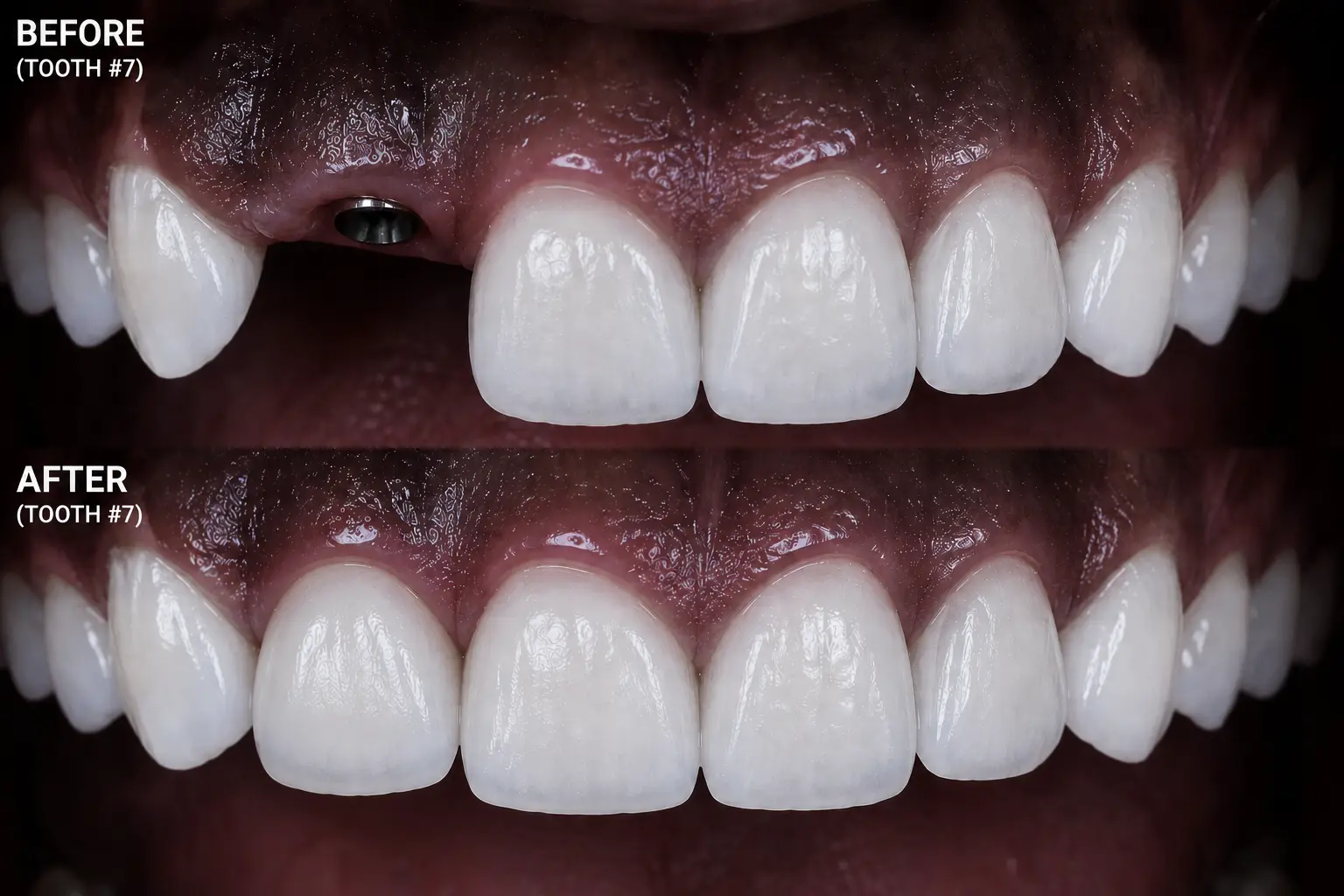 Custom zirconia implant crown placement on healed dental implant