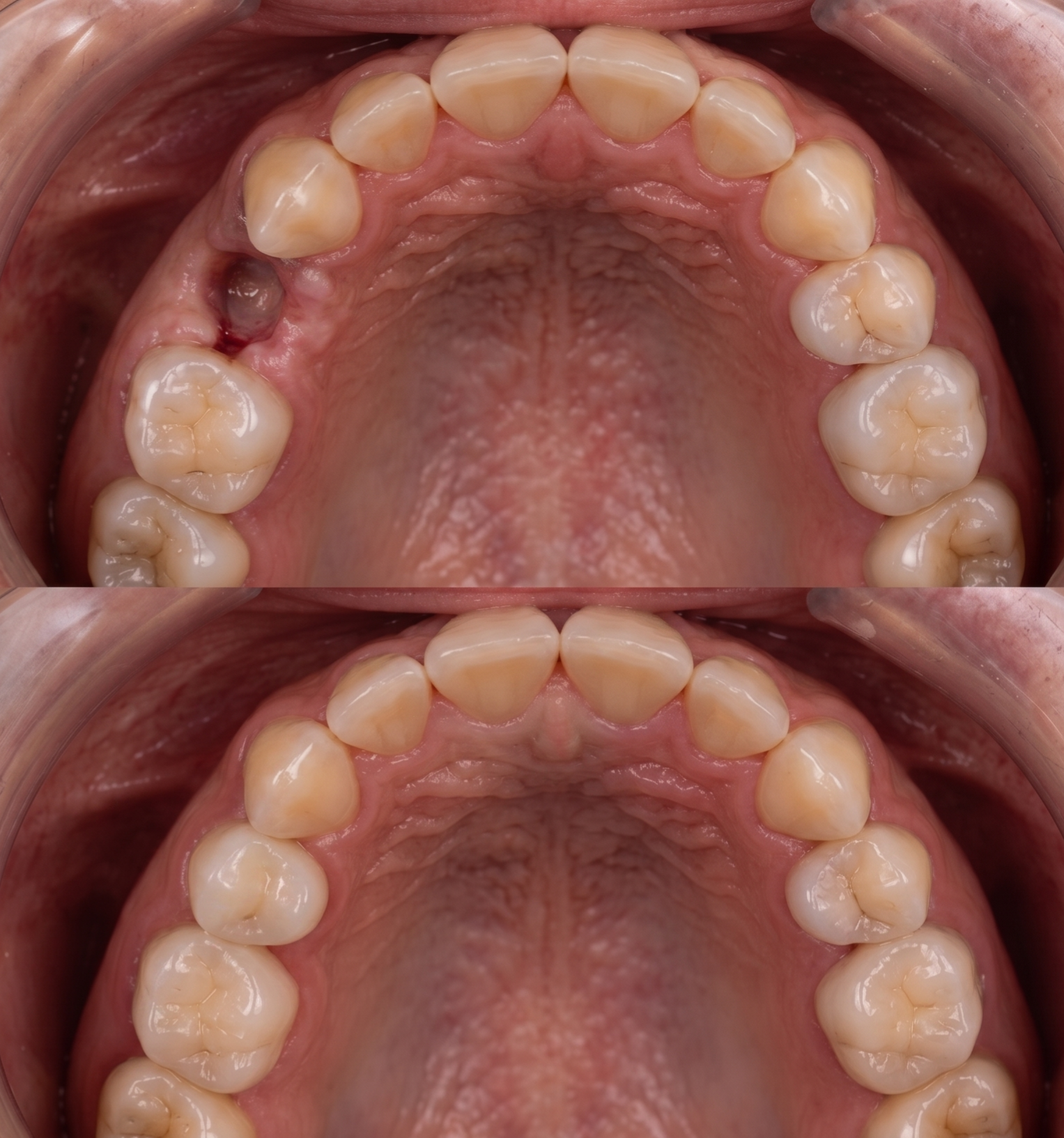 Premolar dental implant before and after at A-Dental Center North Hollywood