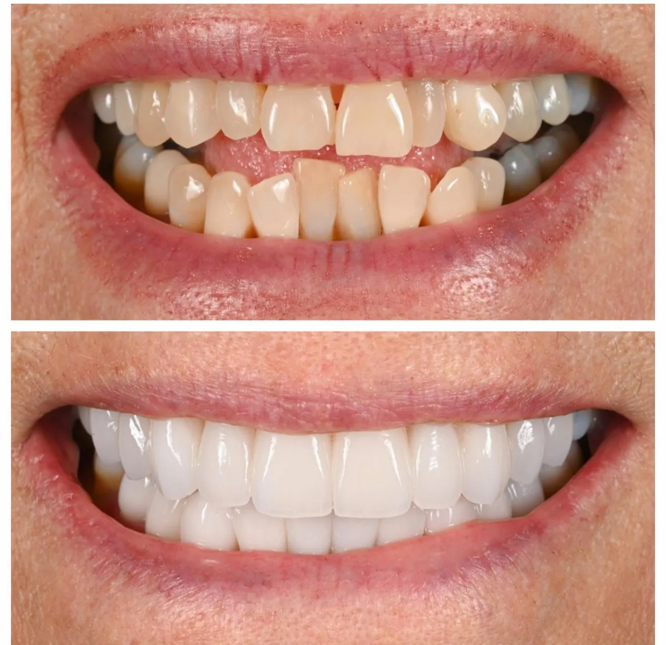 Porcelain veneers before and after full smile transformation at A-Dental Center in North Hollywood