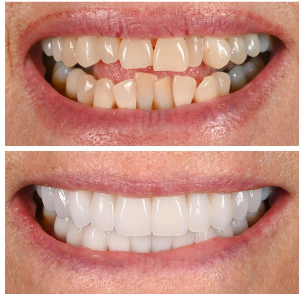 Dental veneers North Hollywood before after — smile transformation A-Dental Center results