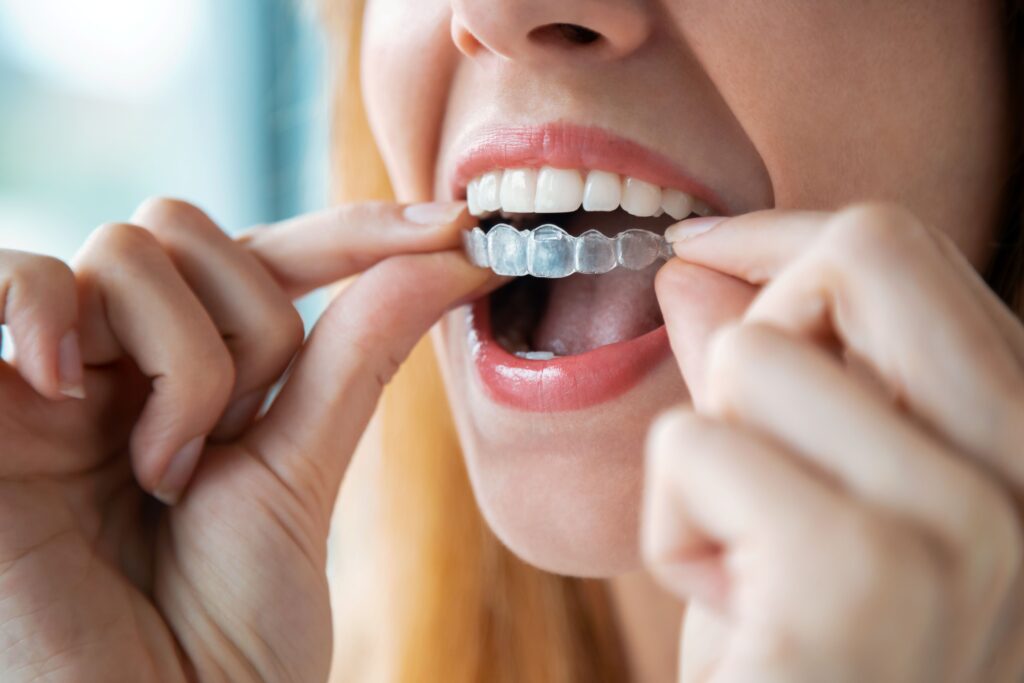How long does Invisalign take adults North Hollywood — clear aligner timeline A-Dental Center