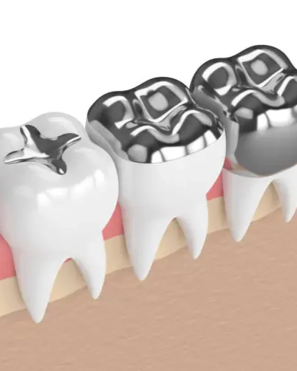 Composite Metal-Free Fillings