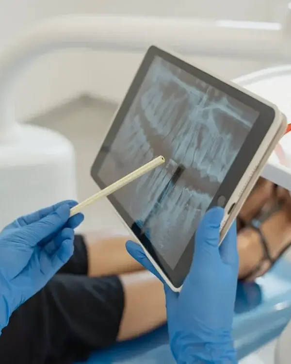 how long does a root canal take North Hollywood Dentist near North Hills